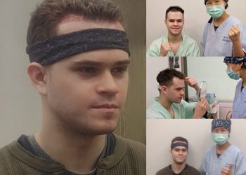 美國工程師來台『微植髮』 指名『國際認證』醫師 完成植髮的夢想