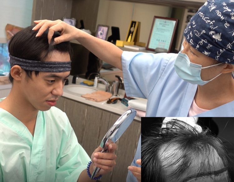 雙11還在搶生髮水? 『髮際線植髮』迎新年