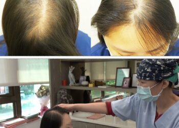 女性落髮Q&A 輕植髮女子專科門診 幫幫妳