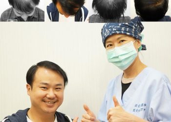 長出來了嗎 ? 演員 地球李嘉文植髮六個月成果分享