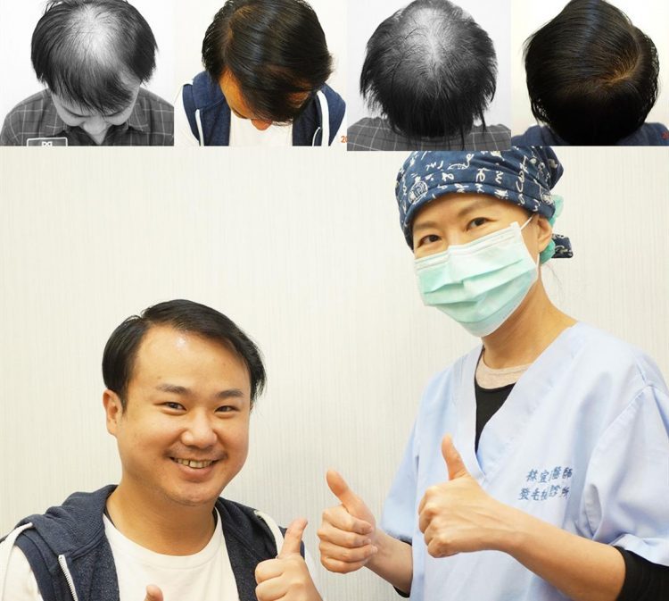 長出來了嗎 ? 演員 地球李嘉文植髮六個月成果分享