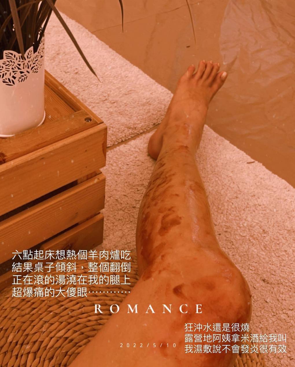 台版三上悠亞再曬辣照 E奶發威抖音追蹤數破百萬 網紅露營意外燙傷腿部 曝心理層面更難康復