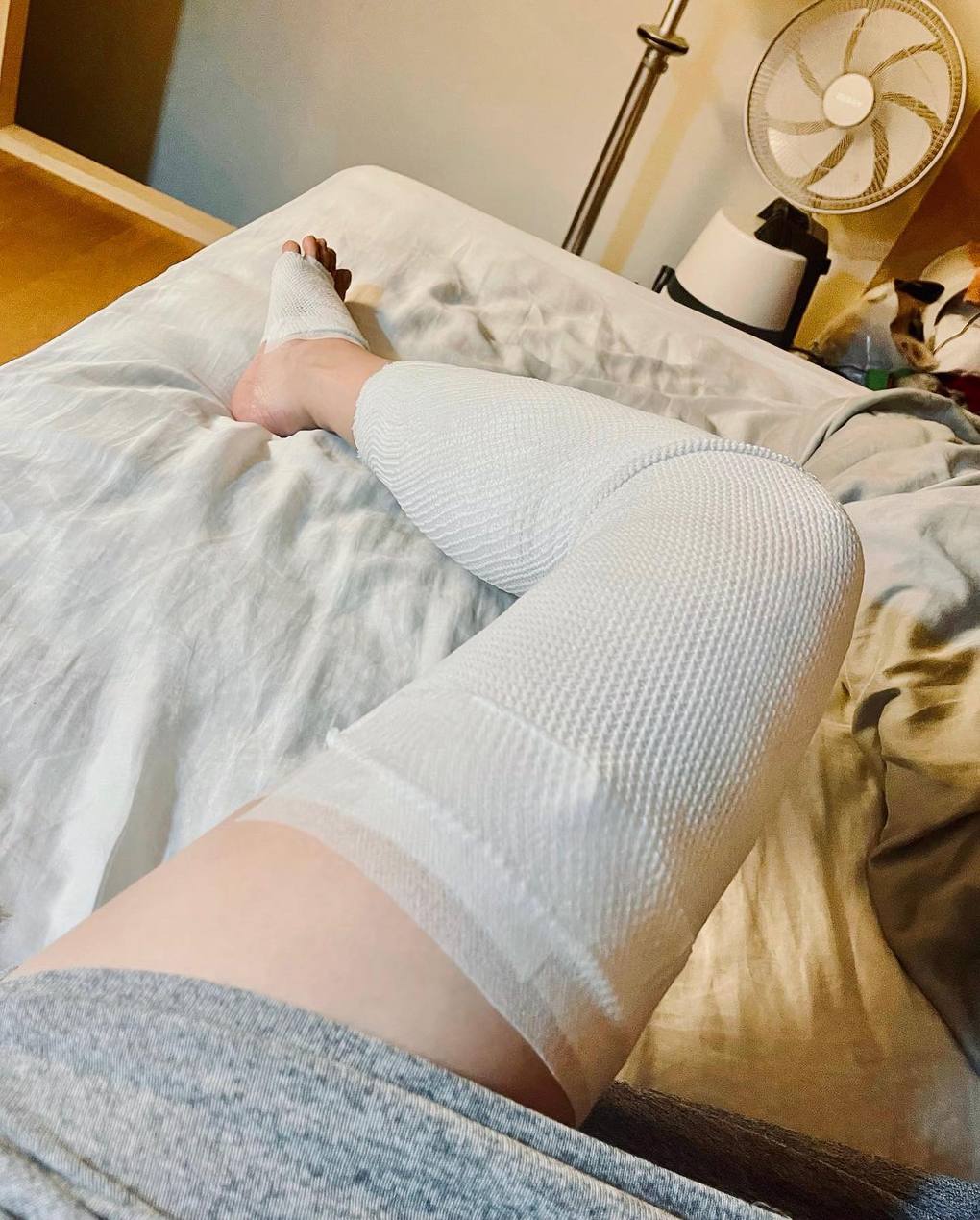 台版三上悠亞再曬辣照 E奶發威抖音追蹤數破百萬 網紅露營意外燙傷腿部 曝心理層面更難康復