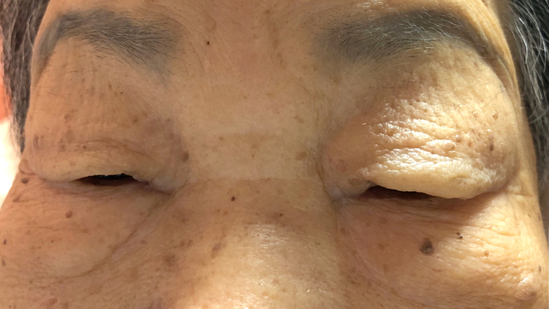 八旬嬤「泡泡眼」體重還爆增一度快破百！醫揪病因：竟是「它」惹禍
