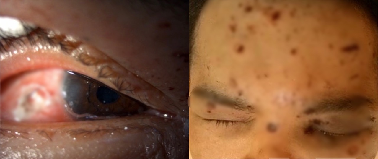 4旬男使用「卡式爐」引發氣爆！碎片高速噴濺險失明