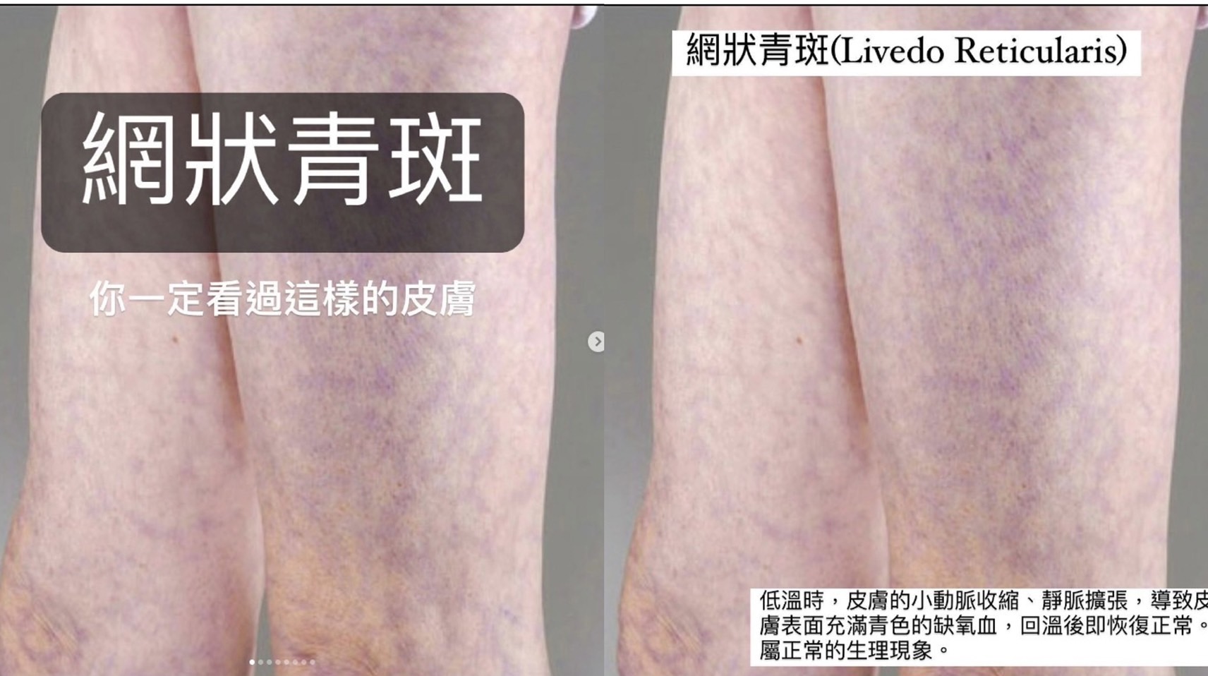 天氣變冷就爆「網狀青斑」！醫：好發在健康嬰兒、年輕女性