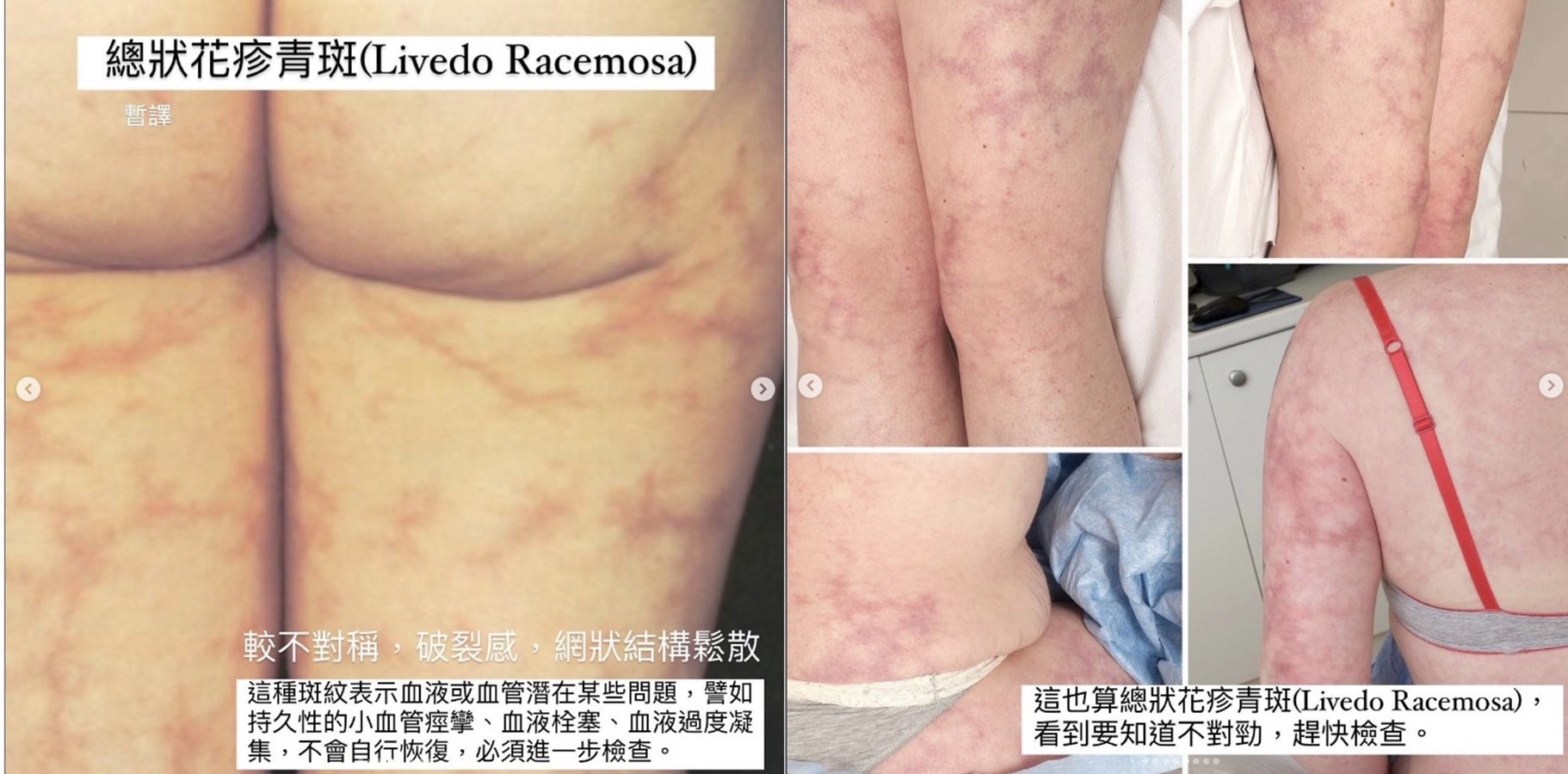 天氣變冷就爆「網狀青斑」！醫：好發在健康嬰兒、年輕女性