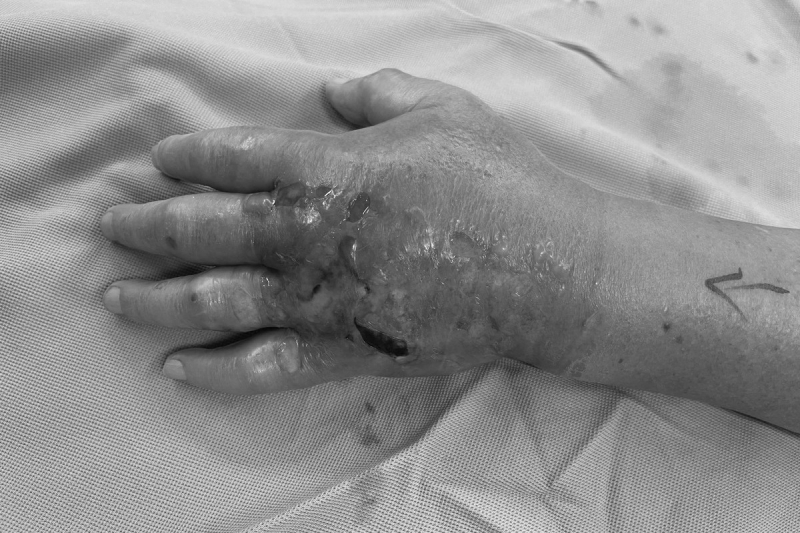 老翁吃魚被刺傷！竟引發壞死性筋膜炎…一度休克，竟是「這1致命菌」搞鬼