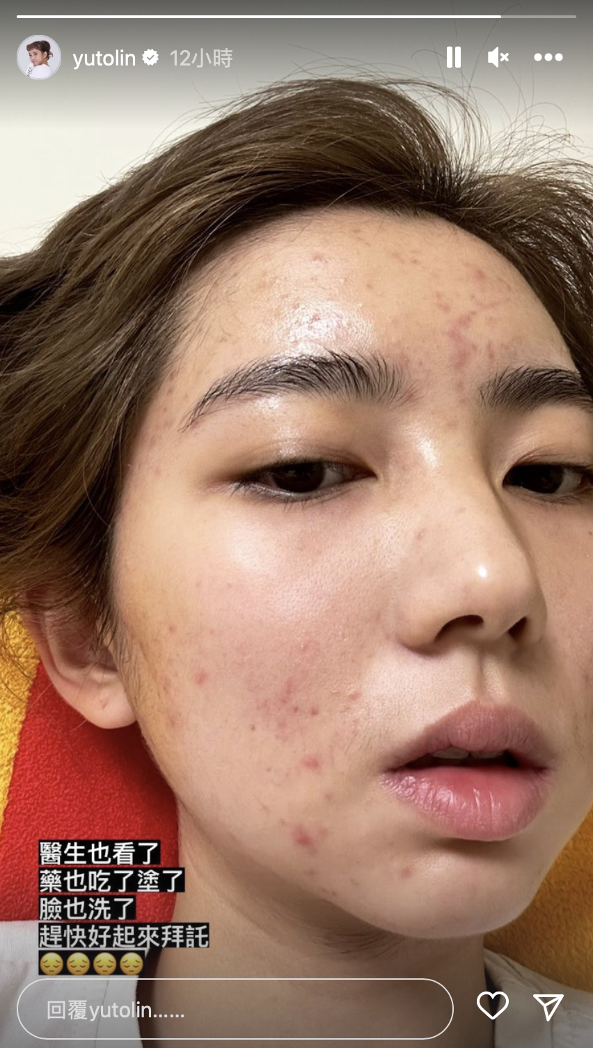林玉書深夜突曬素顏慘狀！全臉爬滿紅疹　無奈嘆：趕快好起來⋯