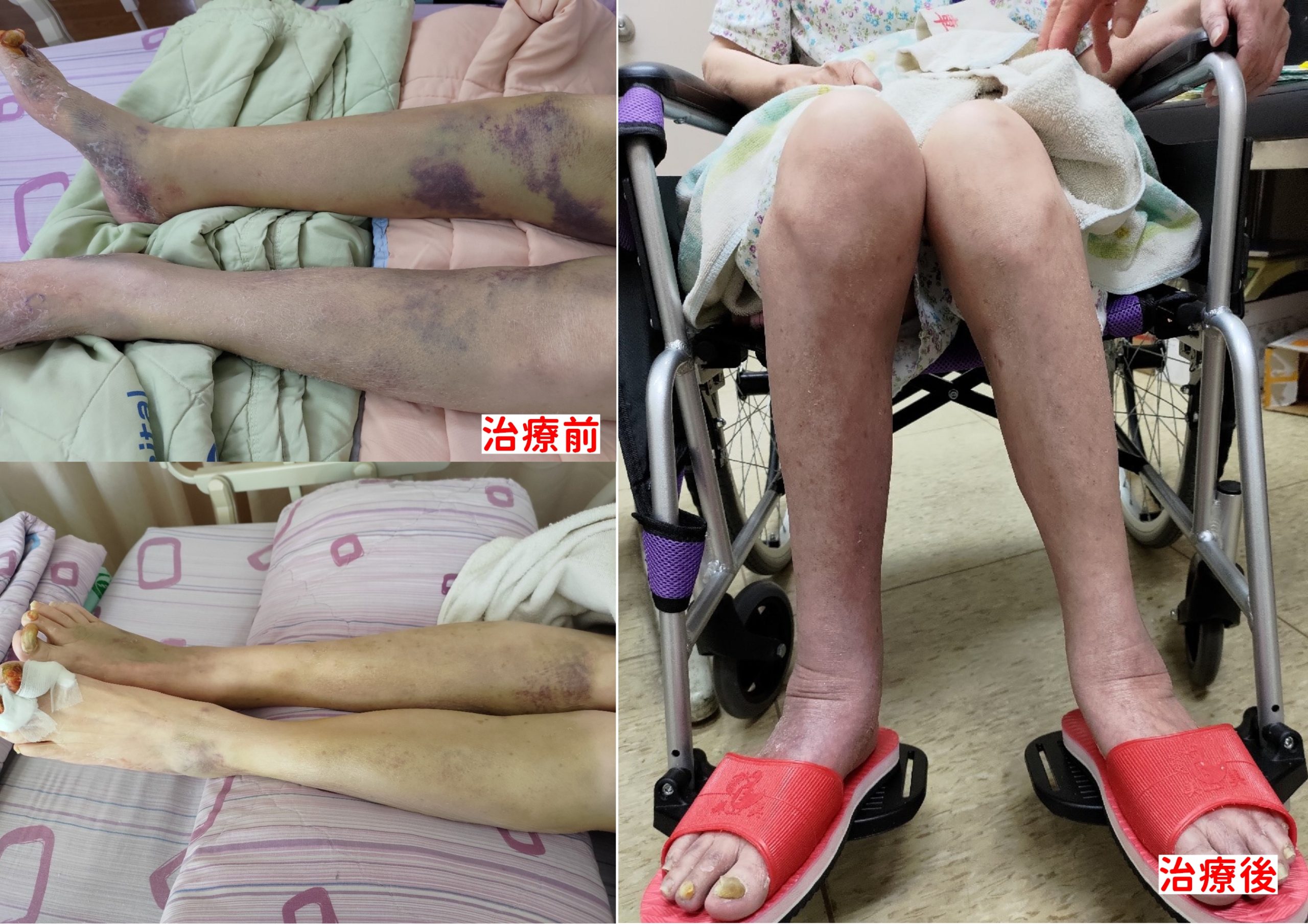 阿嬤看電視久坐 雙腿莫名「大片瘀青」急送醫！醫曝「這類人」要小心