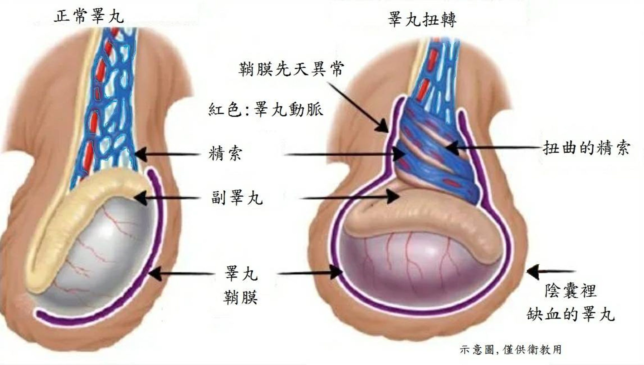 蔡 伊 達 醫 師 表 示.鞘 膜 先 天 異 常 者.較 易 發 生 睪 丸 扭 轉.(圖臺 北 醫 院 提... 蛋 蛋 劇 痛"醫....