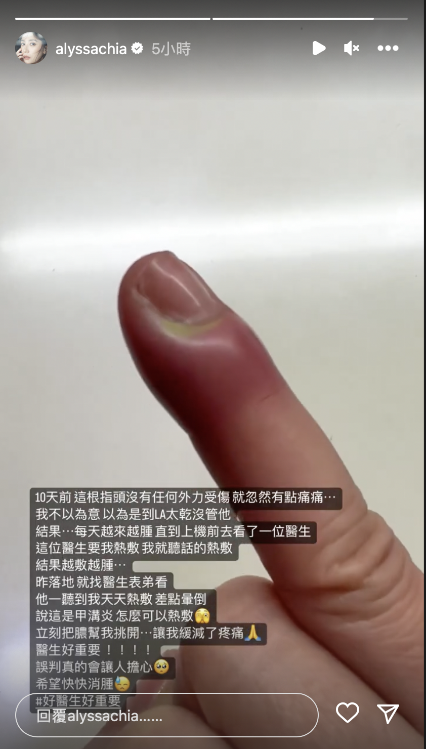 賈靜雯手指腫脹發紫天天熱敷　回台驚覺被誤診：好醫生好重要！