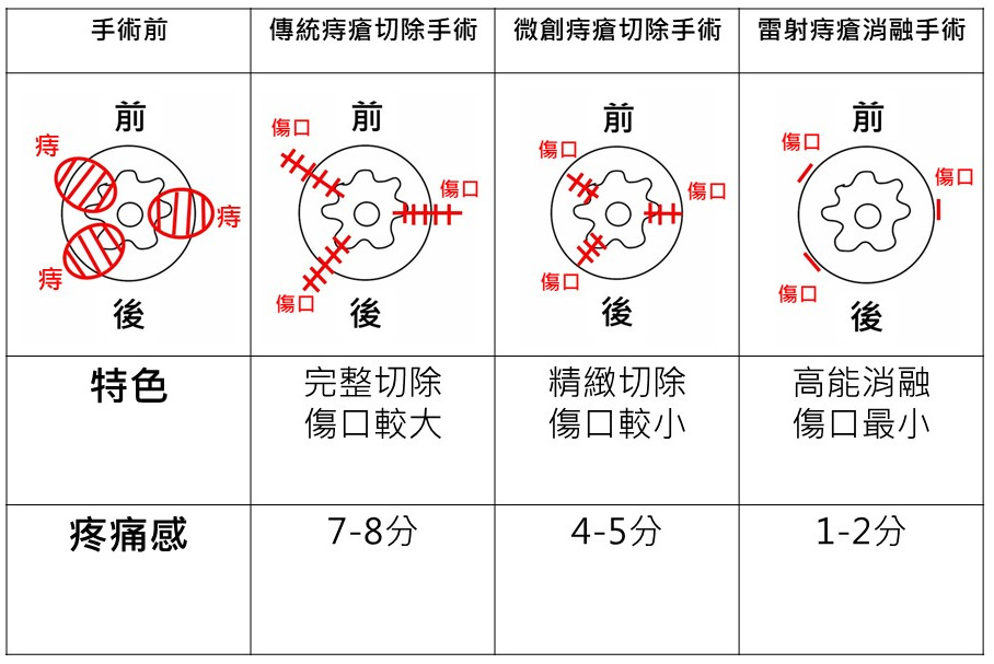 男子肛門口竟有小肉球外露 「雷射消融手術」擺脫痔瘡困擾