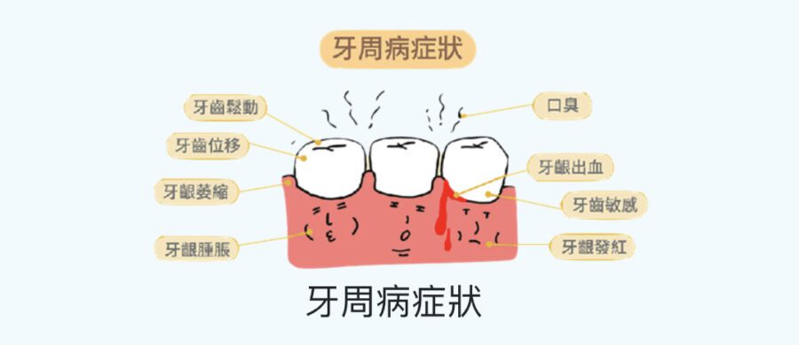 50歲翁咬排骨牙鬆晃動！牙醫師：中度牙周病導致