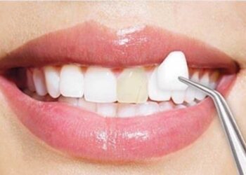 美白貼片適合哪些人?-牙醫師歐凱捷:這些牙齒問題更合適