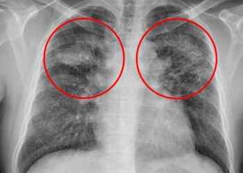 不可逆且將持續惡化！胸腔科醫師呼籲當心可怕「矽肺症」