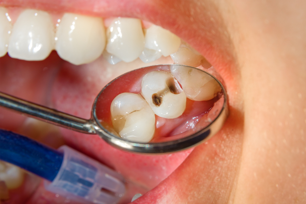 健康從「齒」開始！預防蛀牙，北市寒假期間提供免費塗氟服務！