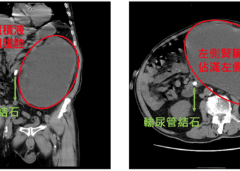 老翁腎臟反覆感染 靠達文西手術成功根除