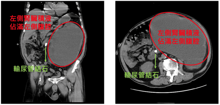 老翁腎臟反覆感染 靠達文西手術成功根除