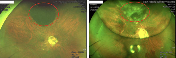 罕見眼內惡性黑色素瘤,中國附醫微創手術成功保留視力! 罕見眼內惡性黑色素瘤,中國附醫微創手術成功保留視力!