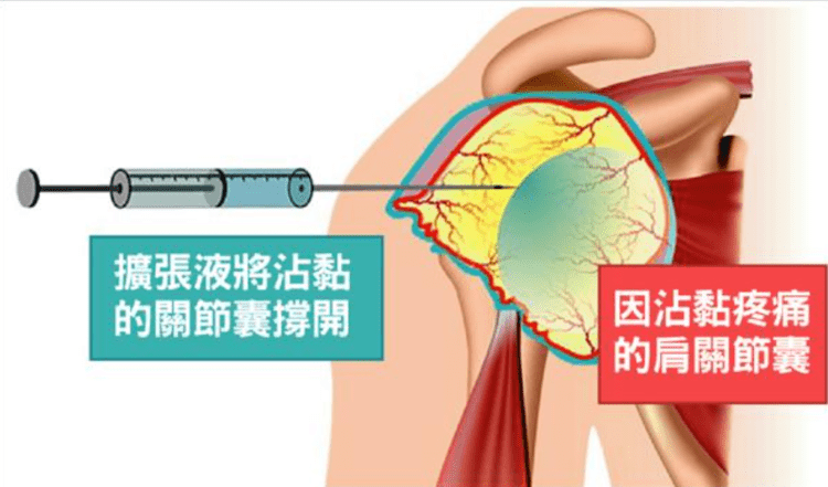 五十肩中西結合的診斷與治療新選擇 五十肩中西結合的診斷與治療新選擇