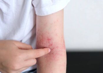 異位性皮膚炎自我照護 食衣住行注意事項一次掌握