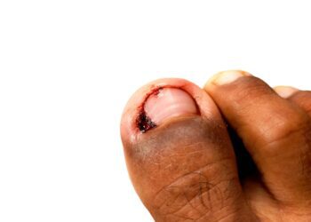 甲溝炎發作先別動，修剪不慎恐惹蜂窩性組織炎上身？！