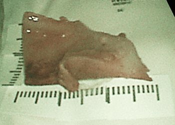 驚！6公分軟骨卡喉嚨，血壓、心跳驟升，醫用胃鏡夾出！