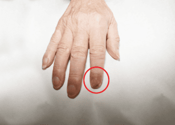 指甲傷口老是好不了-可不能輕忽-小心可能是皮膚癌