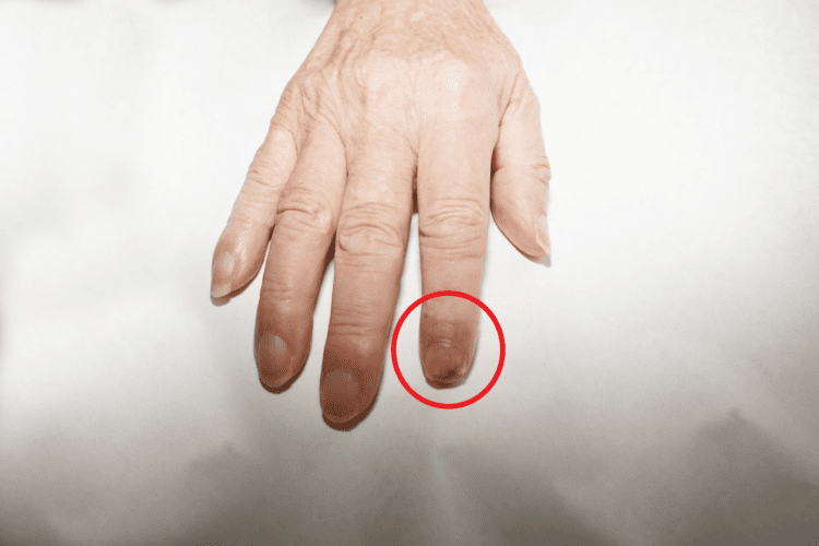 指甲傷口老是好不了 可不能輕忽 小心可能是皮膚癌 指甲傷口老是好不了-可不能輕忽-小心可能是皮膚癌