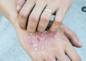 皮膚病也會致命！醫揭乾癬「這類型」全身長滿膿疱⋯恐高燒、器官衰竭