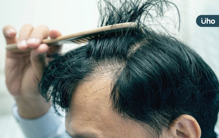 女性交友第一印象先看「有沒有禿頭」!調查揭「NG行為」恐加劇落髮 女性交友第一印象先看「有沒有禿頭」!調查揭「ng行為」恐加劇落髮