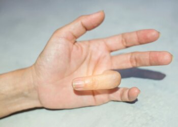 折手指不只關節變粗，恐罹罕見「指部厚皮症」醫曝男性1族群好發