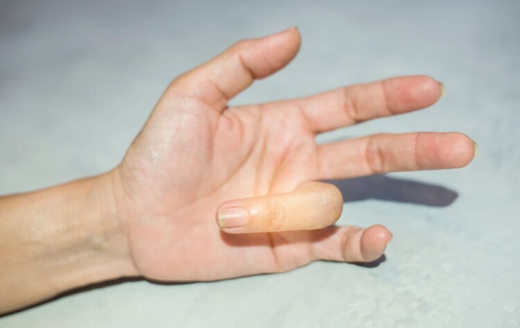 折手指不只關節變粗,恐罹罕見「指部厚皮症」醫曝男性1族群好發 折手指不只關節變粗,恐罹罕見「指部厚皮症」醫曝男性1族群好發