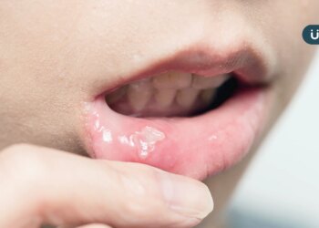 嘴破別再抹鹽巴！嘴破原因、治療方法一次看：貼「1物」比口內膏更好