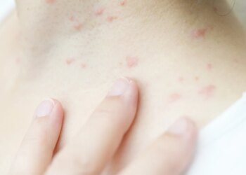 天氣悶熱汗皰疹來襲-專業中醫肺脾腎三臟腑調理減症狀