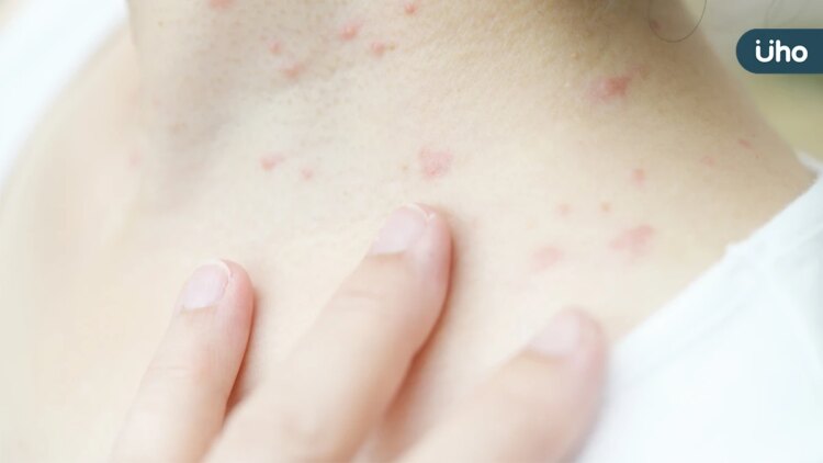 天氣悶熱汗皰疹來襲 專業中醫肺脾腎三臟腑調理減症狀 天氣悶熱汗皰疹來襲-專業中醫肺脾腎三臟腑調理減症狀