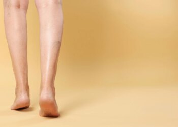 夏日靜脈曲張大作戰：六招教你擊退腫脹痛，告別蚯蚓腿！