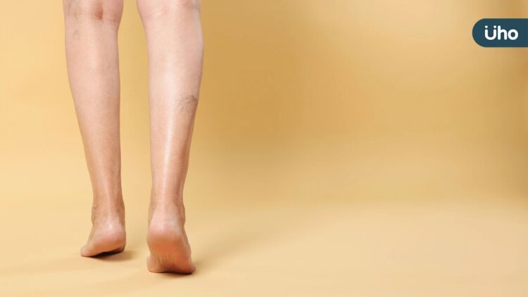 夏日靜脈曲張大作戰:六招教你擊退腫脹痛,告別蚯蚓腿! 夏日靜脈曲張大作戰:六招教你擊退腫脹痛,告別蚯蚓腿!