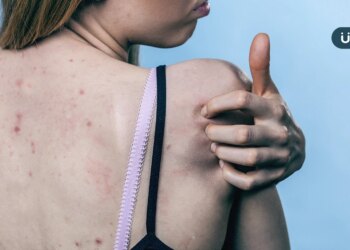 青春痘不只長臉上！醫揭「背痘」5大特徵：有臉痘者半數也長背痘