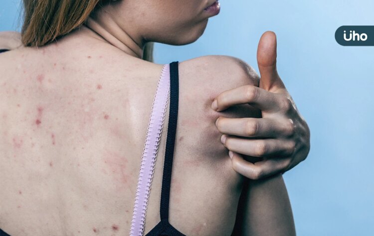 青春痘不只長臉上!醫揭「背痘」5大特徵:有臉痘者半數也長背痘 青春痘不只長臉上!醫揭「背痘」5大特徵:有臉痘者半數也長背痘