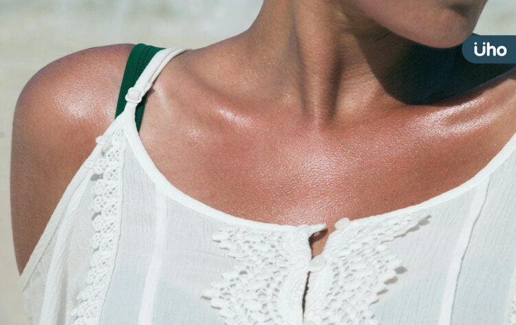 夏天曬傷怎麼辦?皮膚發紅脫皮、長水泡⋯皮膚科醫:就醫前快做1事 夏天曬傷怎麼辦?皮膚發紅脫皮、長水泡⋯皮膚科醫:就醫前快做1事