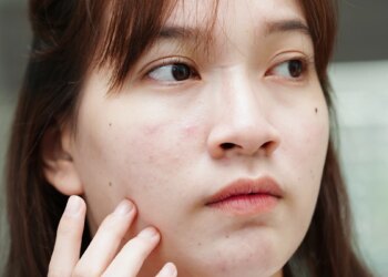 便秘原來和惱人痘痘肌有關-改善便祕可抗痘