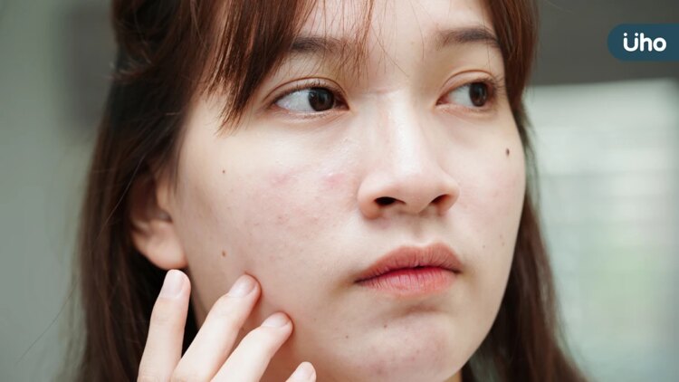 便秘原來和惱人痘痘肌有關 改善便祕可抗痘 便秘原來和惱人痘痘肌有關-改善便祕可抗痘