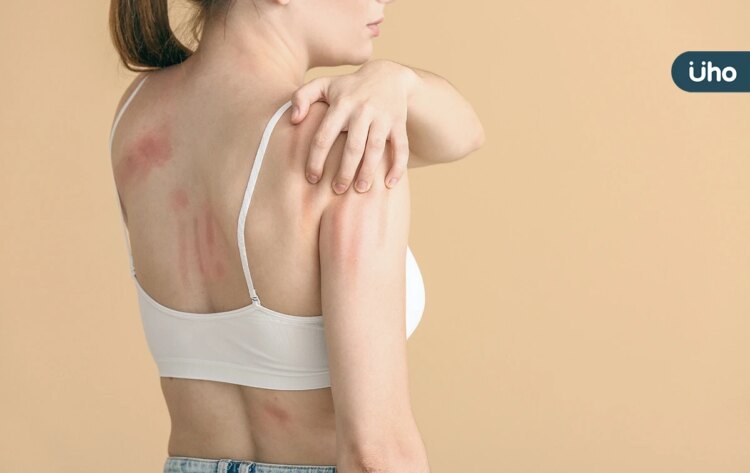 蕁麻疹皮膚癢不是食物過敏?醫揭慢性蕁麻疹「好發2時間」復發有解 蕁麻疹皮膚癢不是食物過敏?醫揭慢性蕁麻疹「好發2時間」復發有解