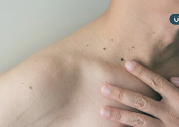 常曬太陽小心皮膚癌！林靜芸揪「基底細胞癌」4大特徵：別誤認痘疤