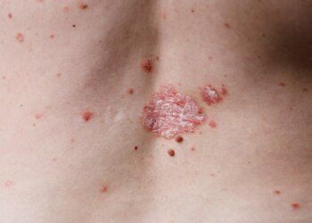 皮蛇（帶狀皰疹）與手摸atm無關：皮膚科專科醫師糾正錯誤報導並提供正確衛教