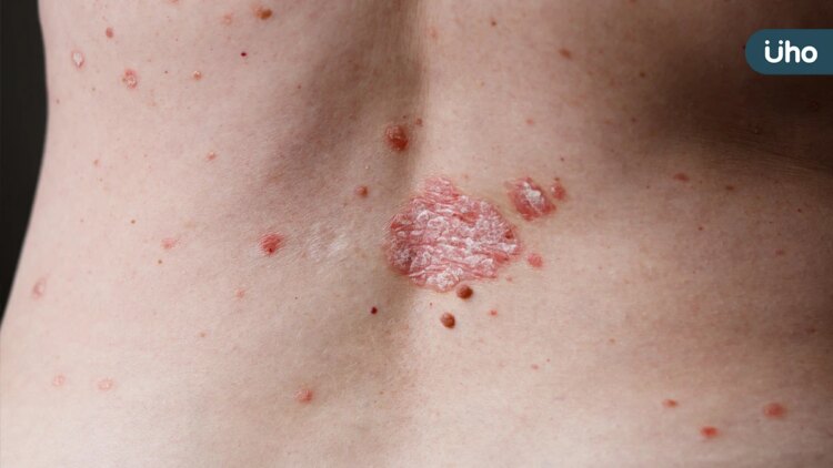 皮蛇(帶狀皰疹)與手摸ATM無關:皮膚科專科醫師糾正錯誤報導並提供正確衛教 皮蛇(帶狀皰疹)與手摸atm無關:皮膚科專科醫師糾正錯誤報導並提供正確衛教