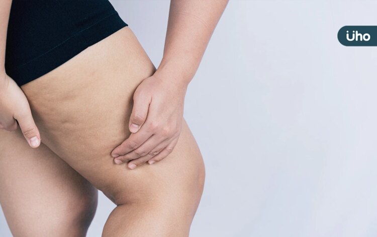 大腿、肚子長橘皮好難看⋯如何消除?不只靠減肥,教你「3招」預防 大腿、肚子長橘皮好難看⋯如何消除?不只靠減肥,教你「3招」預防