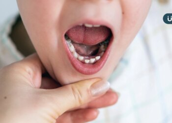 牙齒矯正該從小開始嗎？醫揭「咬合不正」3原因：不一定越早越好